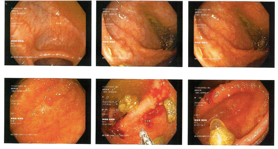 active Left-sided ulcerative colitis